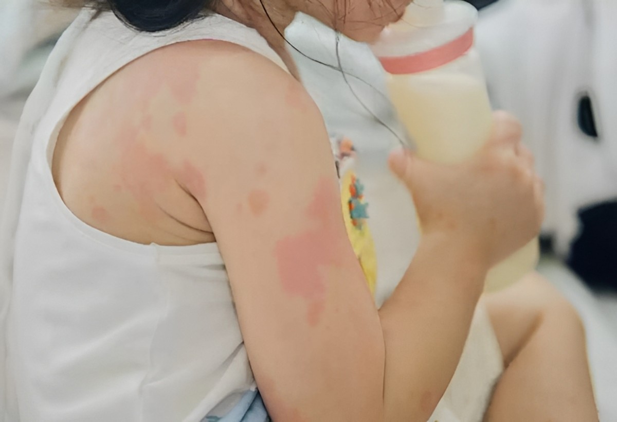 Qida allergiyası uşaqlar üçün təhlükə yaradır: Həkimdən XƏBƏRDARLIQ