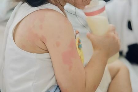 Qida allergiyası uşaqlar üçün təhlükə yaradır: Həkimdən XƏBƏRDARLIQ