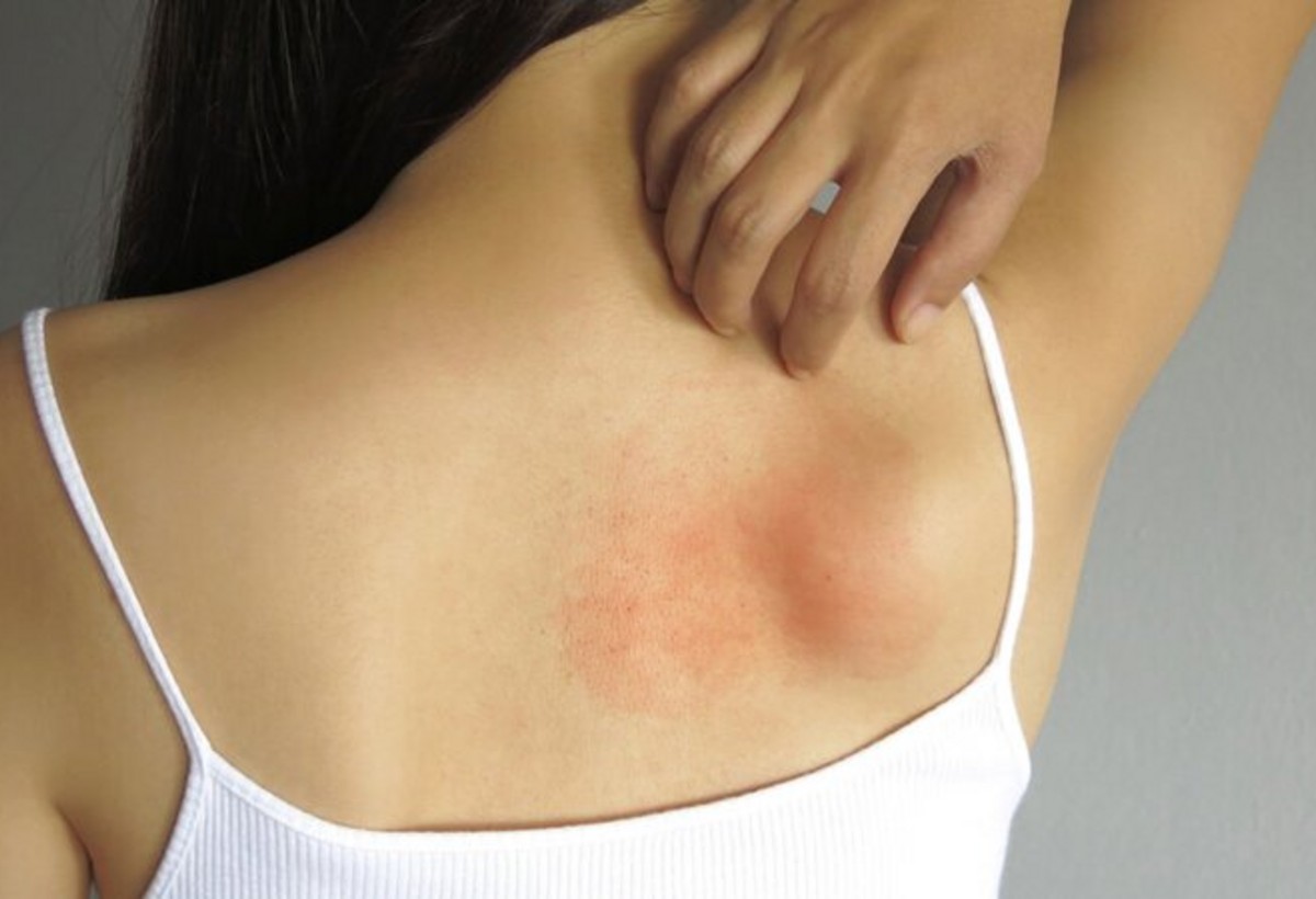 Günəş allergiyasından qorumanın effektiv üsulları - həkim-allerqoloqdan dəqiq izah