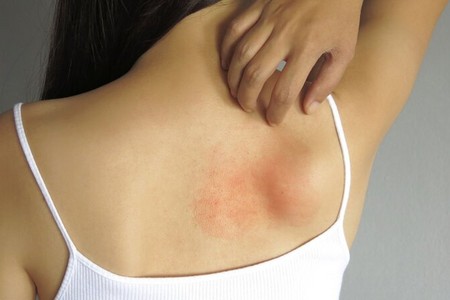 Günəş allergiyasından qorumanın effektiv üsulları - həkim-allerqoloqdan dəqiq izah