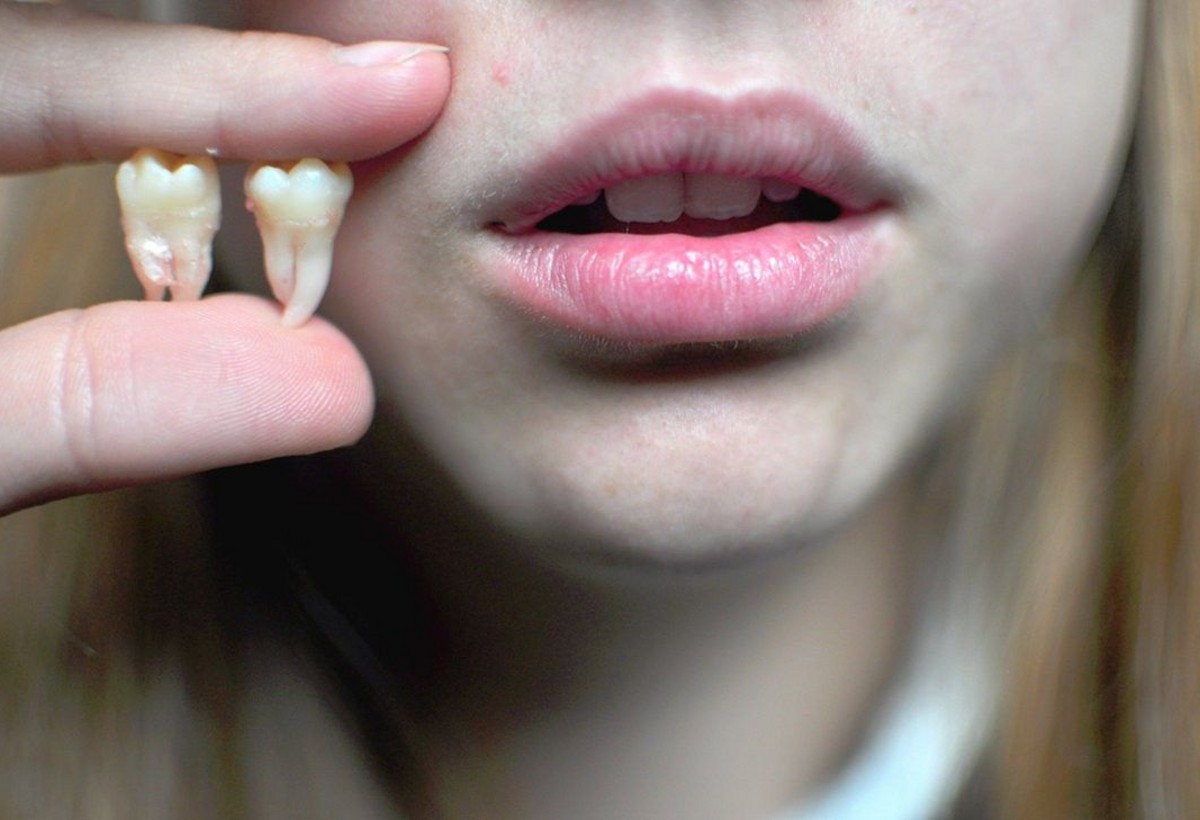 XƏBƏRDARLIQ: Ağıl dişləri gözəl təbəssümünüzü məhv edə bilər
