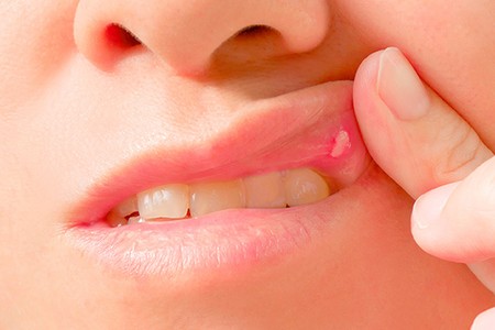 Diş pastası iltihab, ağızda yaralara səbəb olursa nə etməli? - Mütəxəssis açıqlayır