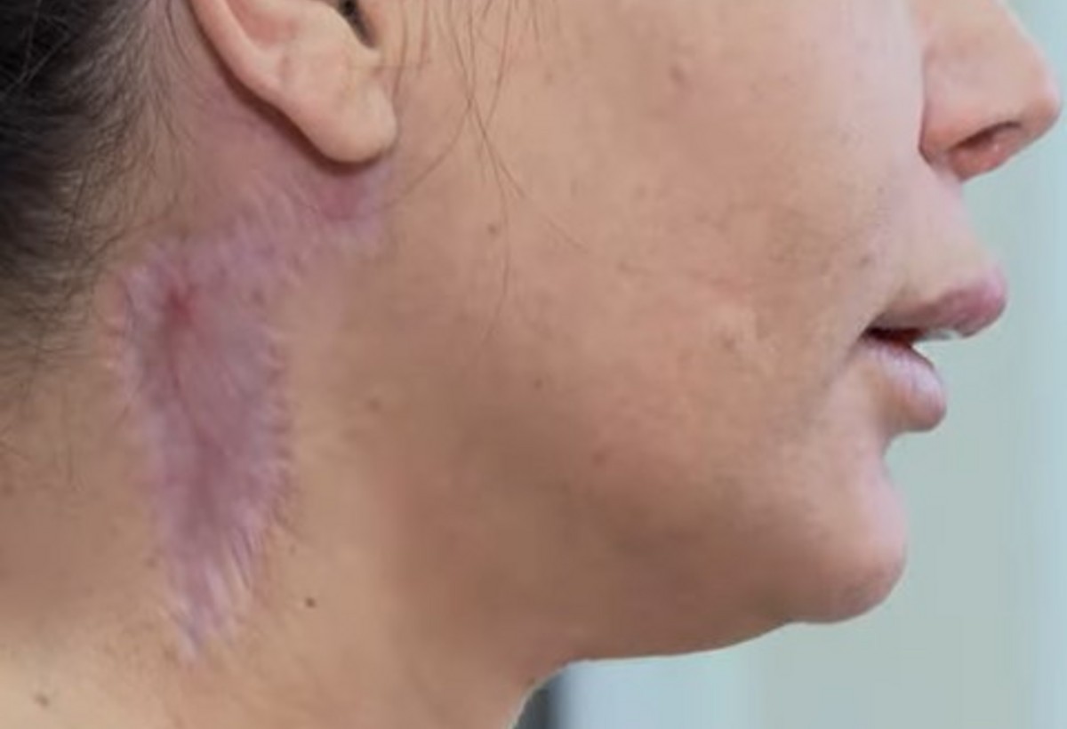 Estetik mərkəzdə olunan boğazgərmə əməliyyatı fəsadlara səbəb oldu - VİDEO