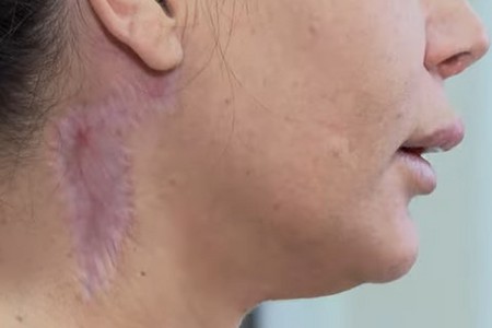 Estetik mərkəzdə olunan boğazgərmə əməliyyatı fəsadlara səbəb oldu - VİDEO