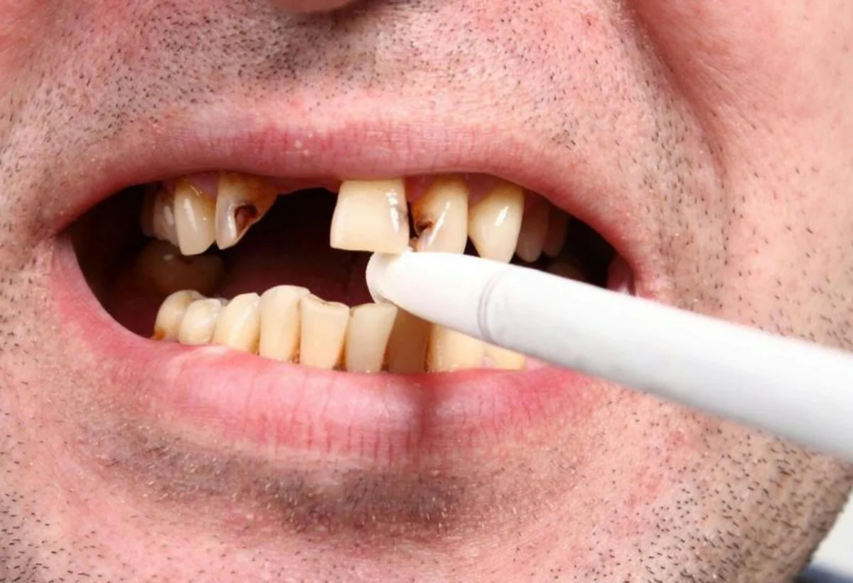 Mütəxəssislər siqaretin diş və ağız sağlamlığına təsirini açıqladı