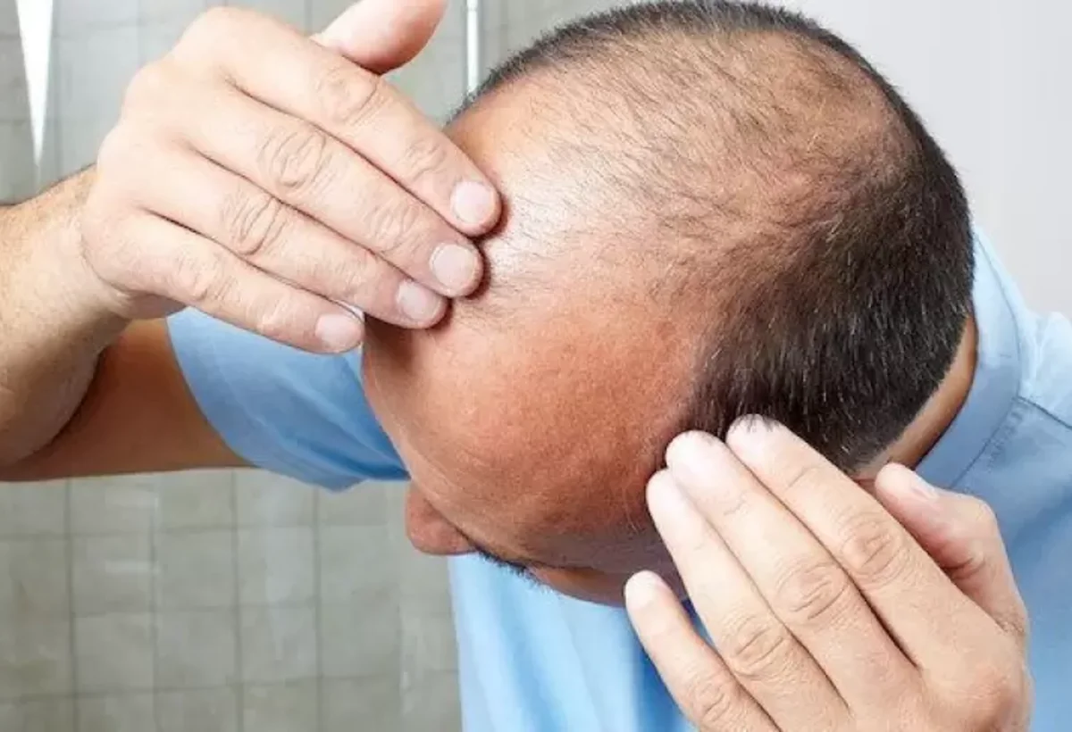 Yuxusuzluq keçəlliyə səbəb olur - XƏBƏRDARLIQ