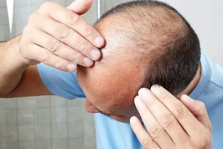 Yuxusuzluq keçəlliyə səbəb olur - XƏBƏRDARLIQ