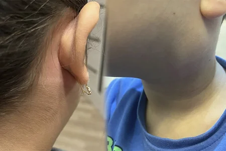 Qulaqdibi xəstəliyinin yayılması ilə bağlı Səhiyyə Nazirliyindən BƏYANAT