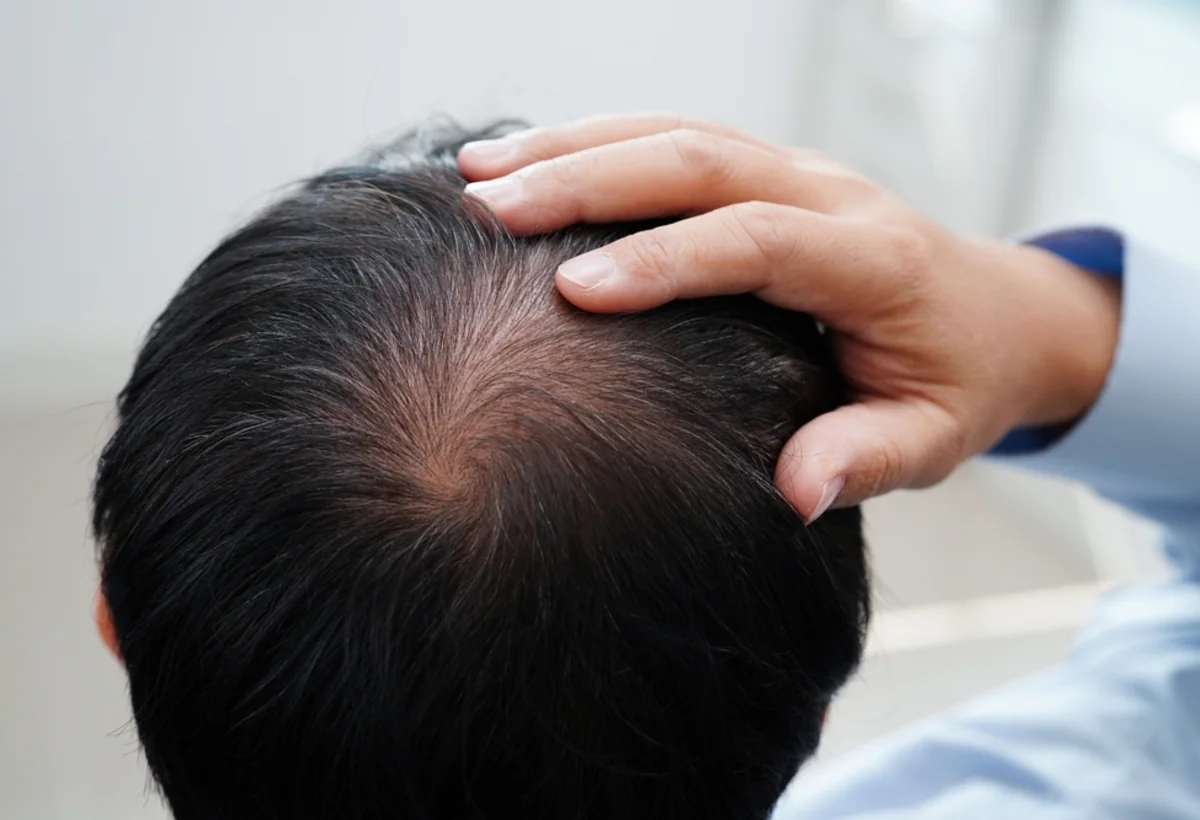 Saç tökülməsinə qarşı hansı üsullar effektivdir?