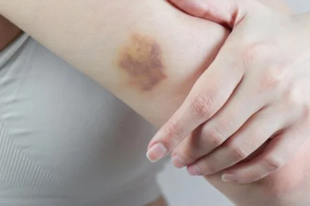 Dəridə qançır əmələ gəlməsi hansı vitamin çatışmazlığına işarə edir?